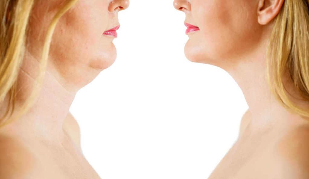 Double Chin treatment Sheffield before and after results