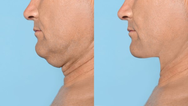 Which Non-Surgical Treatments Work Best for Jowls and Loose Skin Sheffield?