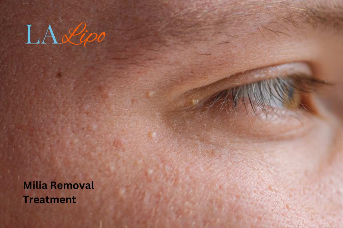 Cryopen Milia Removal: Is It the Easiest and Safest Option Sheffield?