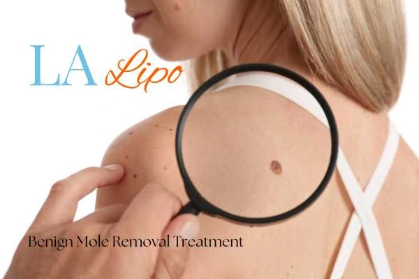 Why getting moles removed Sheffield can boost your confidence!