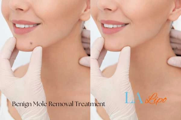 woman's before and after mole removal Sheffield results