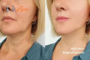 hi-fu for wrinkles Sheffield before and after results