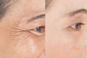 Before and after results of woman - HI-fu wrinkles reduction treatment Sheffield
