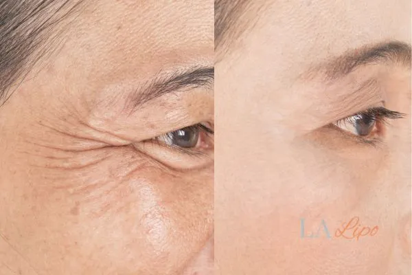 Before and after results of woman - HI-fu wrinkles reduction treatment Sheffield