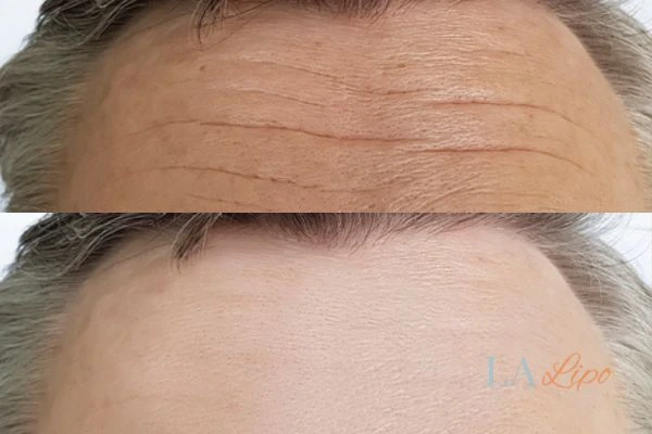 results of HIFU Sheffield on mans forehead to help reduce lines and wrinkles