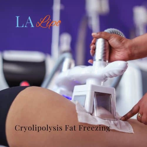 fat freezing - Cryolipolysis Sheffield