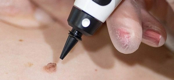skin tag removal using cryopen Sheffield
