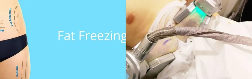 Fat freezing Sheffield on multiple areas of the body