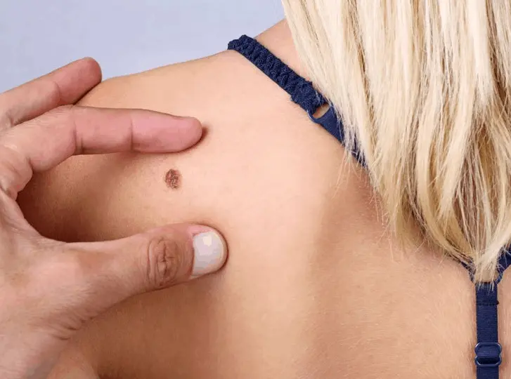 woman having mole removal Sheffield consultation before treatment.