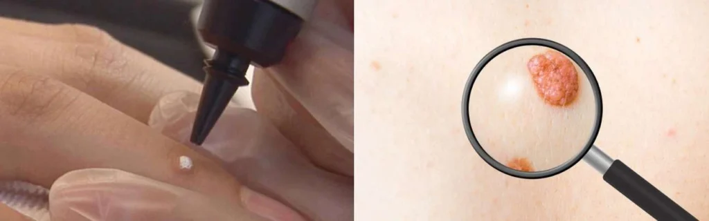 Person getting moles removed with cryopen Sheffield