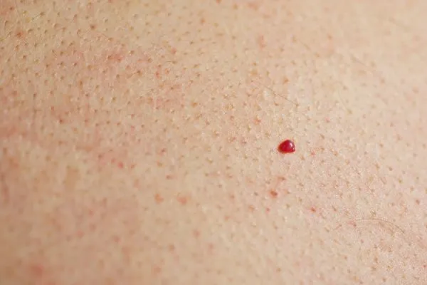 close up of a cherry angioma Sheffield