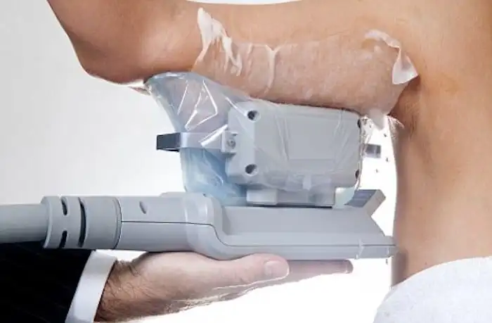 Picture of fat freezing Sheffield on the upper arms.