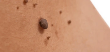 image of a skin tag Sheffield