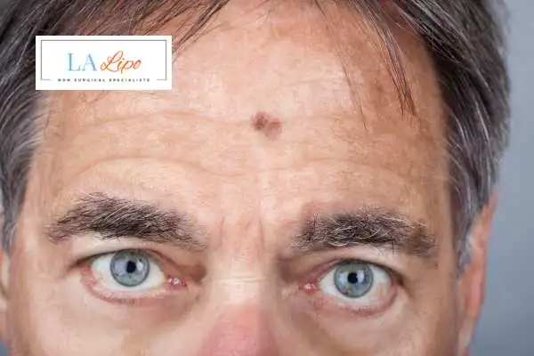 Solar Lentigo Removal Sheffield image of man with mark on his forehead