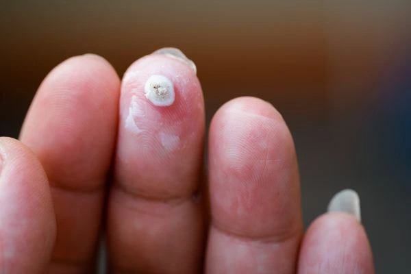 wart on person finger - cryotherapy to treat from LA LIPO Sheffield