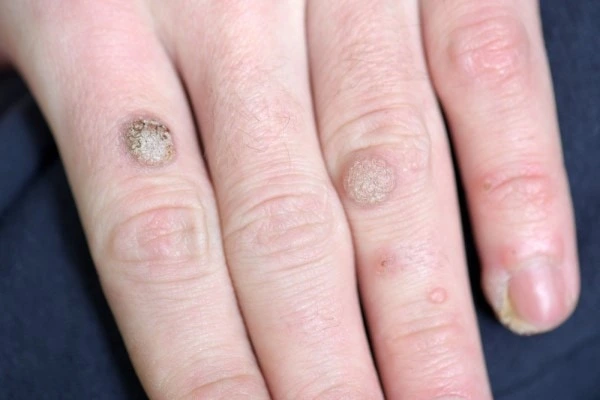 photo of warts on person hand - see wart removal Sheffield from LA LIPO