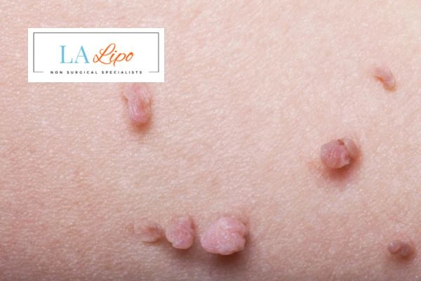 Does cryopen skin tag removal Sheffield hurt? Find out now call our team today!