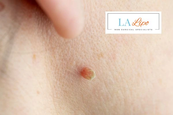 Book skin tag removal Sheffield today speak to our team now!