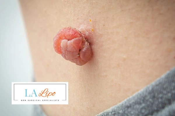 Interested in skin tag removal Sheffield? Concerned about the pain? Find out more today!