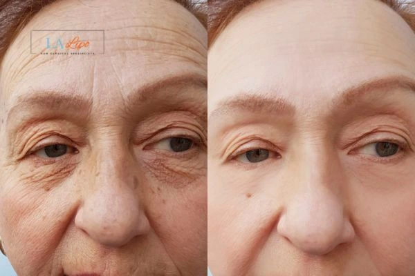 The powerful benefits of Morpheus8 Treatment Sheffield - Call Our team today!