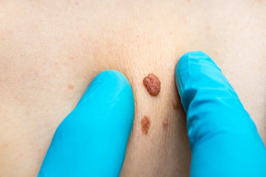 LA LIPO Cryopen Lesion Removal Prices Sheffield