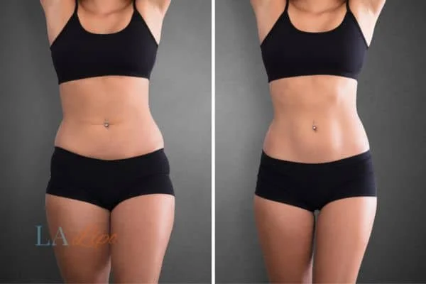 before and after results of non-surgical treatment to help a woman's body image and mental health Sheffield