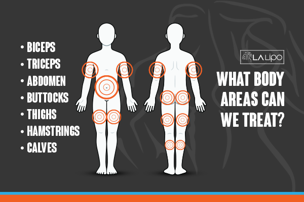 Diagram to show areas you can have LA-EMS Body Sculpting Treatment Sheffield