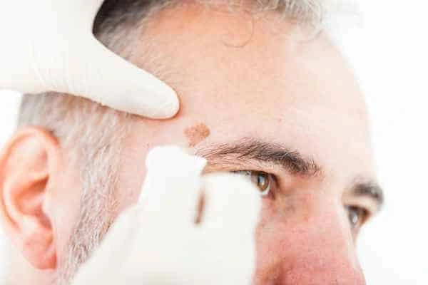 Age spots and elderly people Sheffield what is the link?