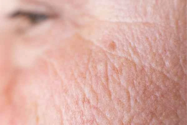 close up picture of a woman's face showing an age spot Sheffield