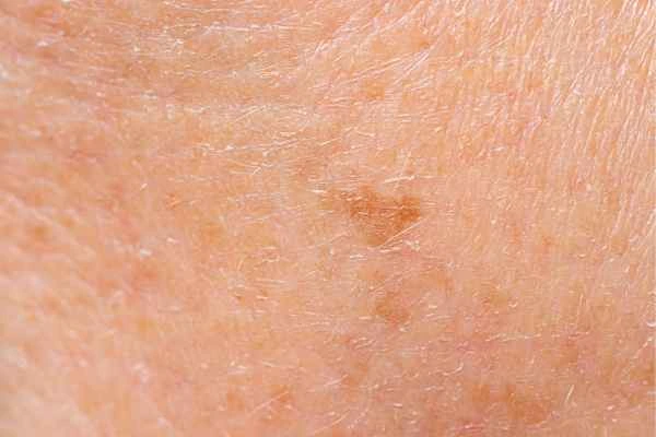 close up picture of age spots Sheffield
