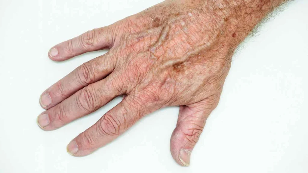 Male hand showing age spot Sheffield