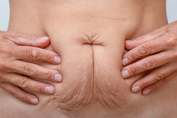 Image of a woman's stomach with loose skin - example of skin tightening Sheffield options
