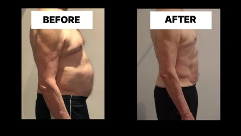 What Symptoms Can Diastasis Recti Cause in Men? Weak Core, Back Pain and Poor Posture Sheffield